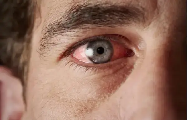 Qué hacer si presentas ojo rojo signos de alerta y tratamientos